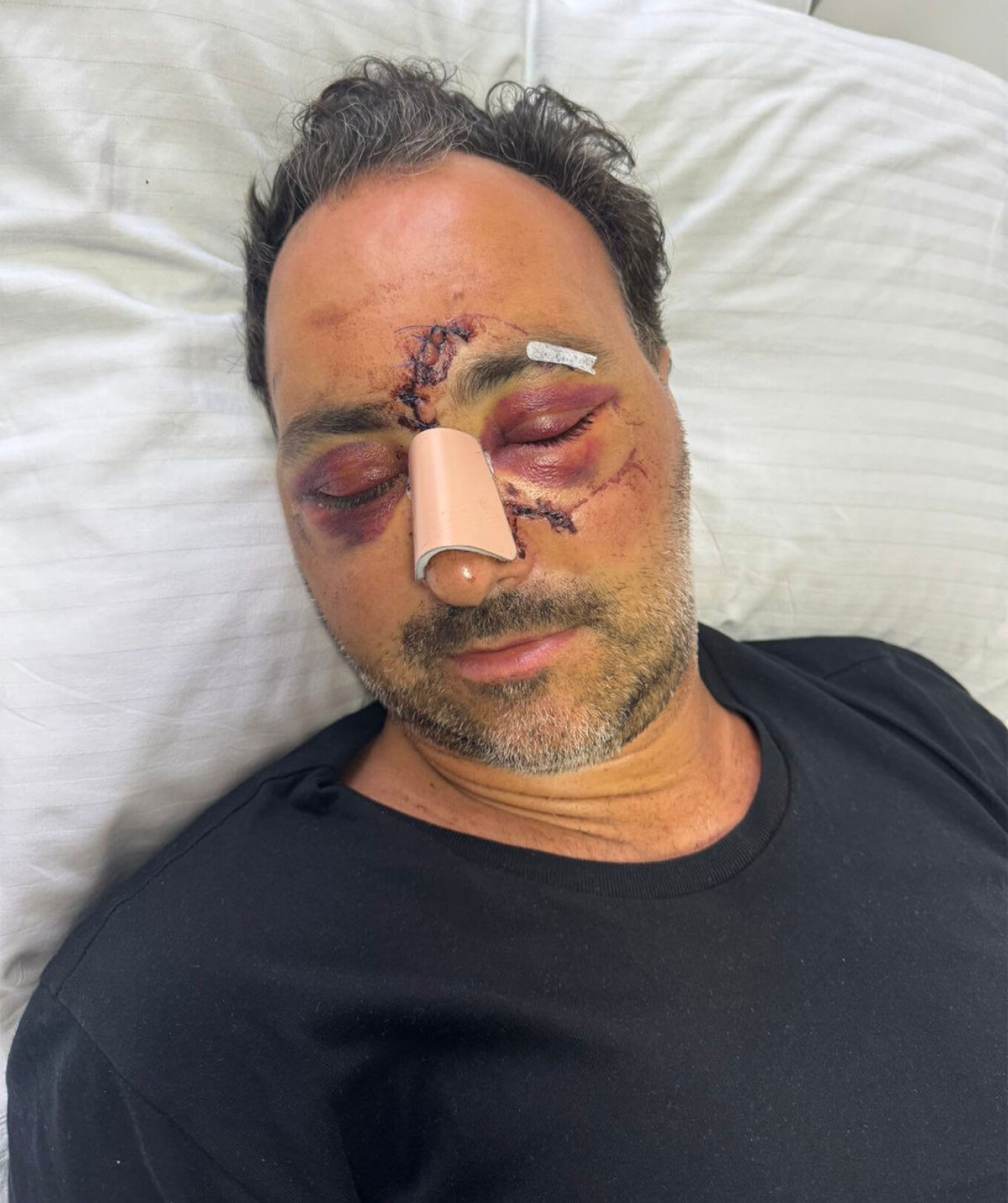  Άγριος ξυλοδαρμός Ελληνοκαναδού χρηματιστή για μια παρατήρηση - Του έκαναν 60 ράμματα στο κεφάλι