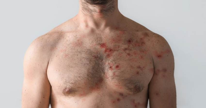 Ευλογιά των πιθήκων μεταδίδεται ευρέως προσυμπτωματικά, έως τέσσερις μέρες πριν τα πρώτα συμπτώματα